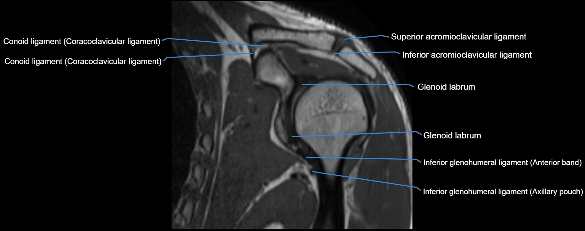 shoulder ligments coronal  cross sectional anatomy 3T MRI AI enhanced radiology image -img-00001-00025.webp